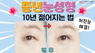 #중년눈성형 처진눈해결 ! 10년 젊어진다..?! #아이루미성형외과