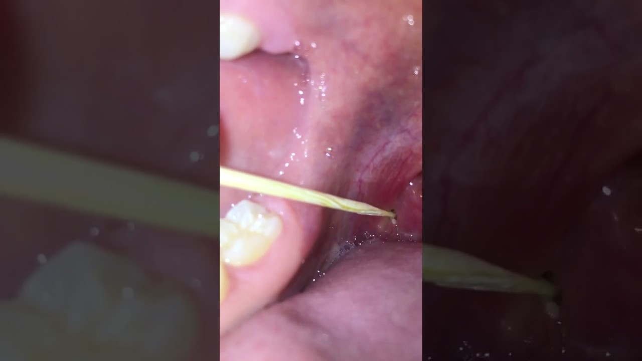 Come togliere le placche alla gola ENORME IMPRESSIONANTE!!!!