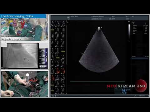 TAVI For Severe Bicuspid Aortic Stenosis