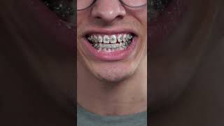 electric toothbrush vs. manual toothbrush