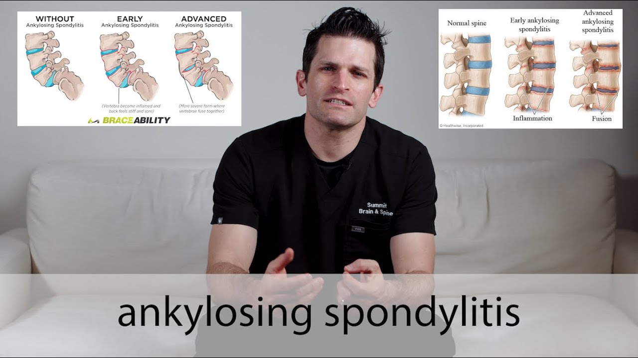 Ankylosing Spondylitis // everything you need to know