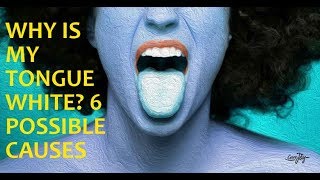 Why Is My Tongue White? 6 Possible Causes