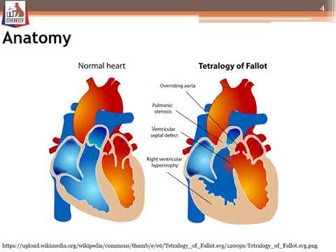 Patient-specific modeling for evalueation of Blalock-Taussig shunt performance