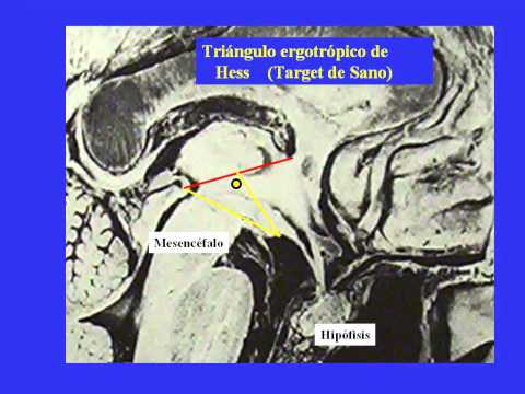 Hipotalamotomia postero medial