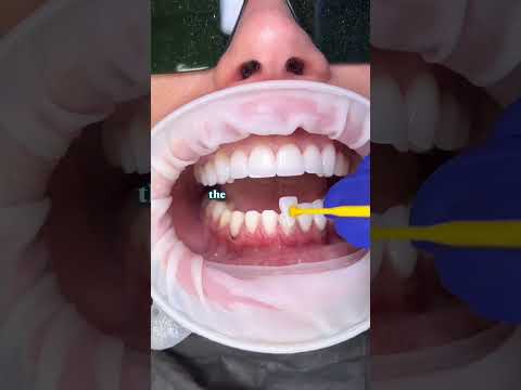 From Composite to Porcelain Veneers 🦷 #dentist #qanda #veneers #composite #porcelain #explained