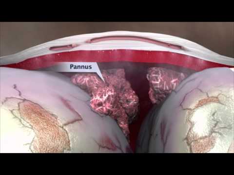 Rheumatoid Arthritis