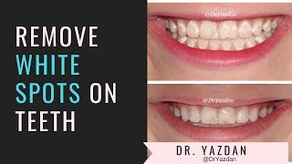 How To Remove White Spots On Teeth | Icon Dental Treatment | Dr. Yazdan