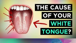 Do You Have A White Tongue (Cause & Treatment)