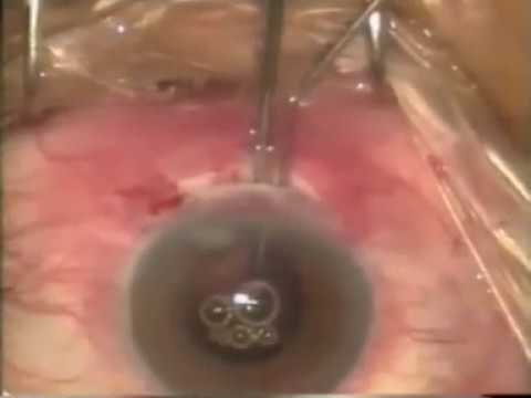Video-IC-APAO-secondary intra shelf PMMA lens Implantation-2