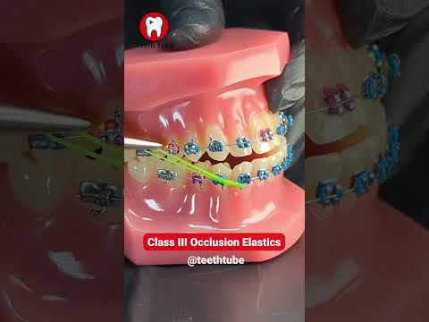 Class III Occlusion Elastics #shorts