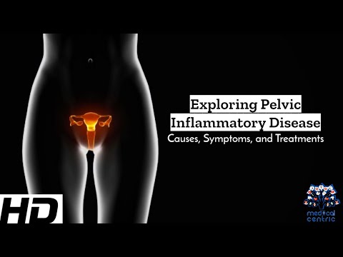 4 Ovarian Cancer Symptoms Every Woman Must Know