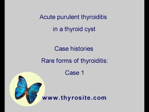 Acute thyroiditis in a thyroid nodule. Rare forms of thyroiditis - case 1: - YouTube