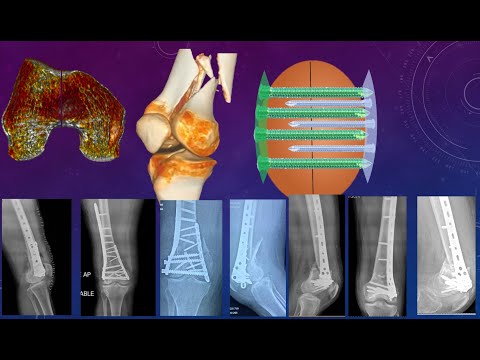 Distal femur fractures Surgical planning