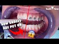 How Braces are put on - Dental Braces Tooth Time Family Dentistry New Braunfels Texas