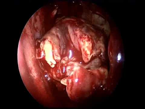 Infraorbital Nerve Schwannoma