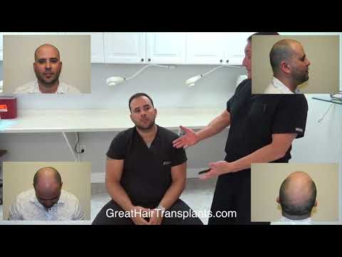 Dr. Brett Bolton Patient Adrien - Pre-Op Consultation For a MaxHarvest&trade; PLUS
