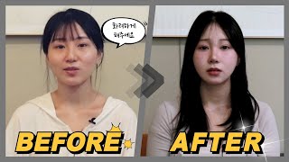 화려함을 원하셨던 성형 후기입니다!!!! 새김성형외과의 재방문의 결과 바로 보시죠! 윤곽, 눈, 코, 심부볼 제거