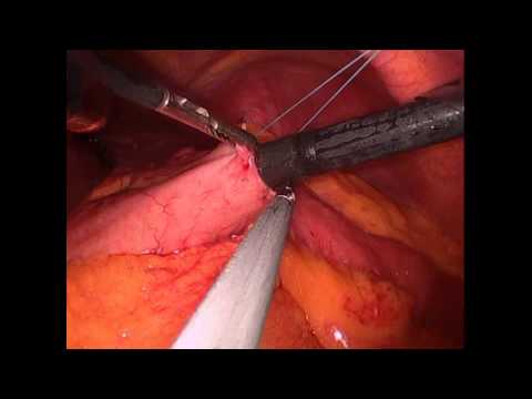 ECPW z wykorzystaniem laparoskopii u pacjenta po zespoleniu omijającym żołądkowo - jelitowym