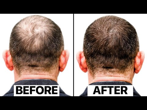 The Truth Behind This New Hair Loss Treatment | Exosomes
