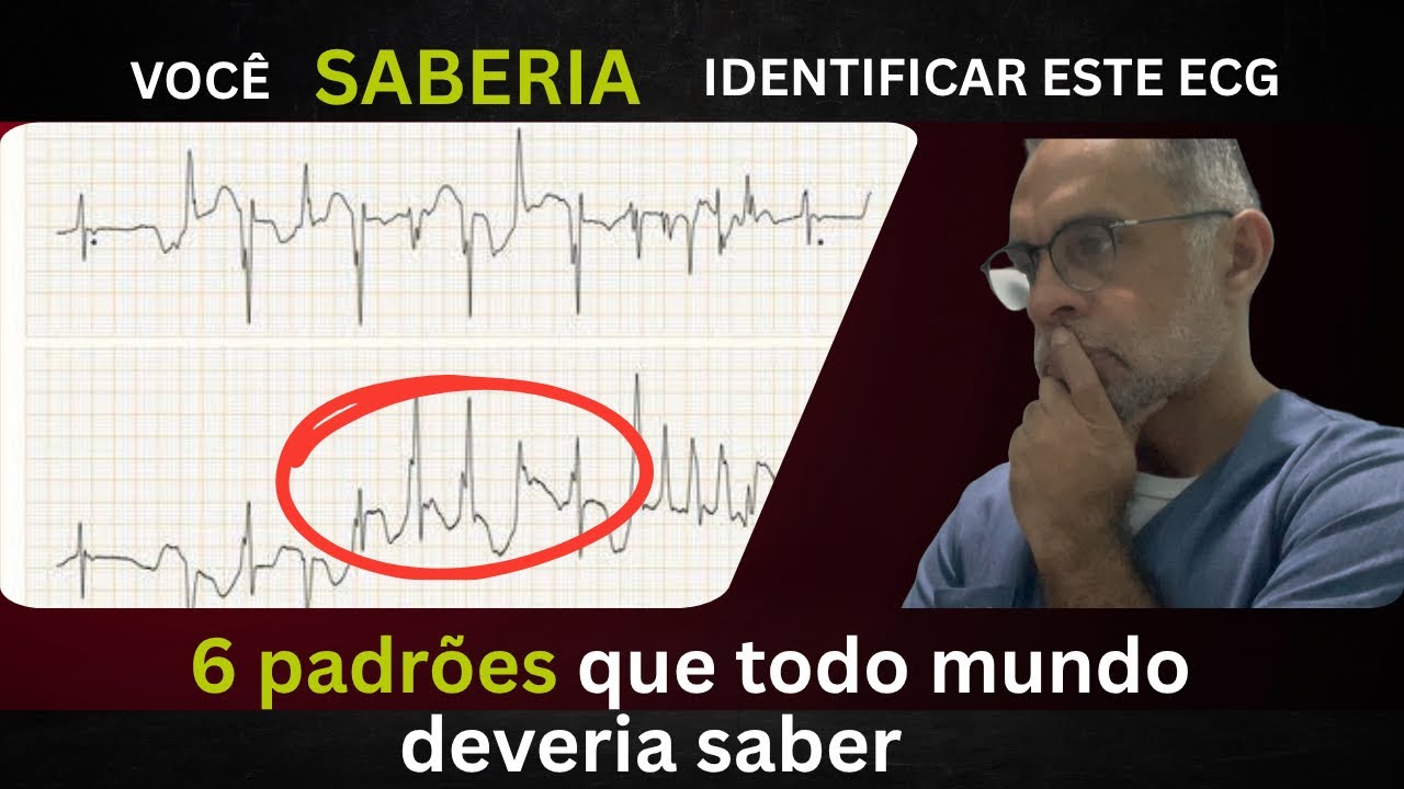 “6 padrões de ECG que todo profissional da saúde precisa reconhecer”