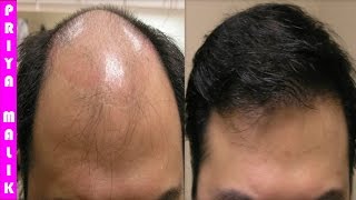 Grow Long Hair, 100% Natural Hair Loss Treatment, Cure Baldness, Remove Dandruff Thin Hair Hair Fall