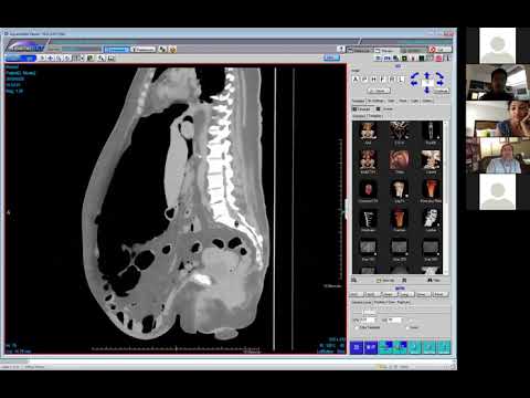 Intentional pneumoperitoneum - why???  (Victoria Chernyak)