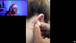 pimple popping on the ear ; cyst squirts all around! cyst explosion