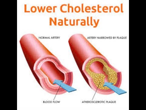 Cholesterol at Sakit sa Puso: Alamin ang Tamang Gamutan -  ni Doc Willie at Liza Ong #384