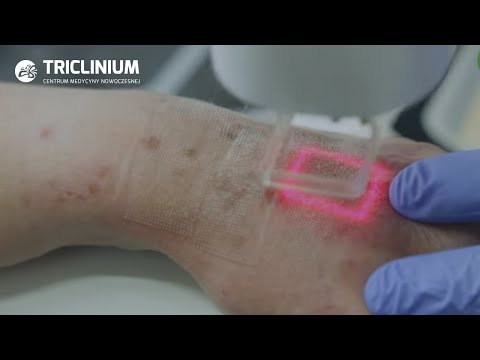 Laserowe odmładzanie dłoni - usuwanie przebarwień starczych | L'Experta