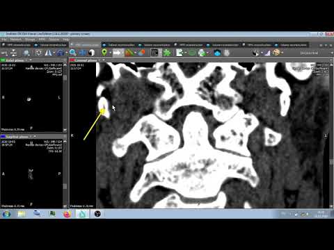 ШИЛОВИДНЫЕ ОТРОСТКИ ckull cronium - (processus  styloideus)
