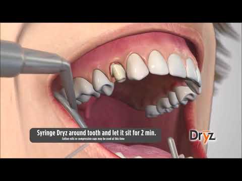 Dryz® Hemostatic Retraction Paste by Parkell Inc
