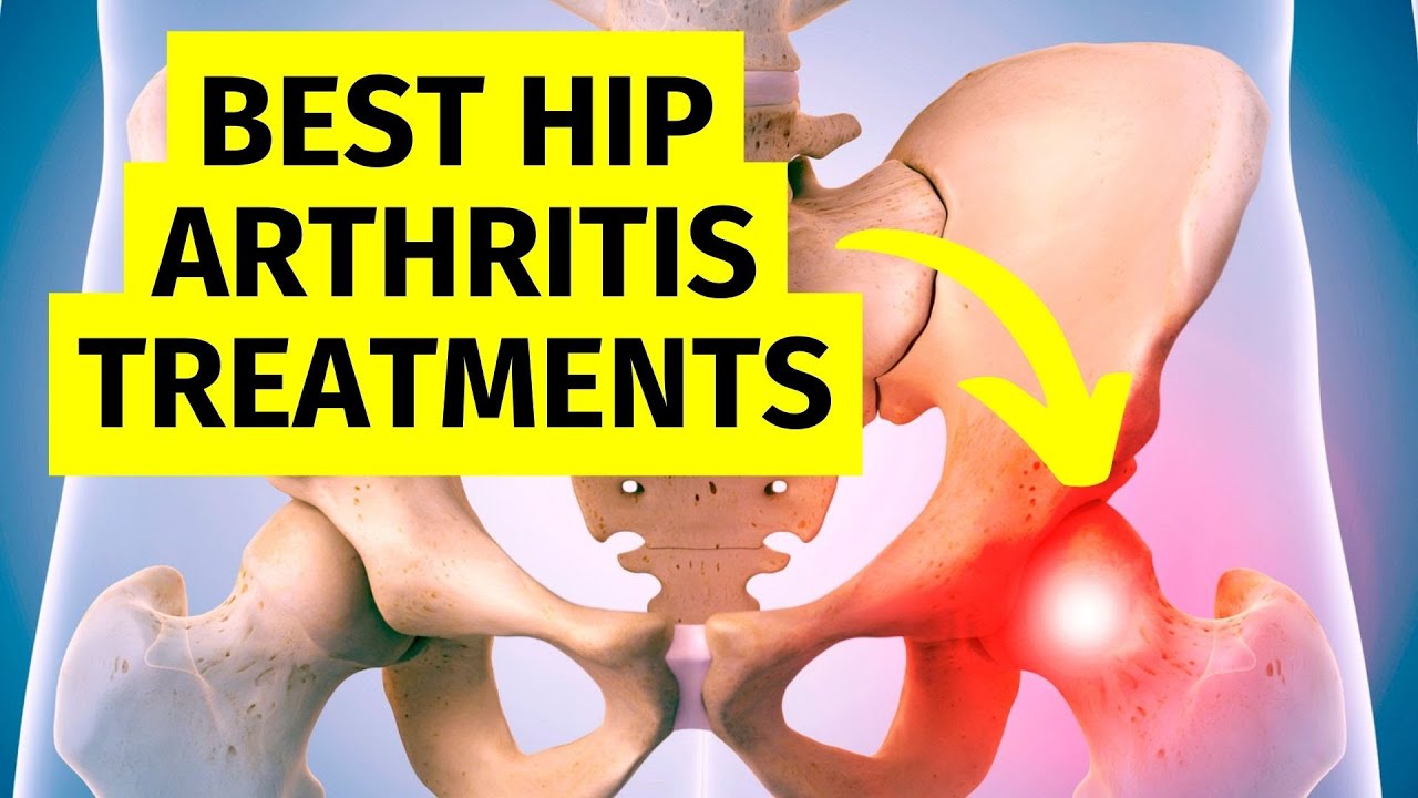 The Best Hip Arthritis Treatments Without Surgery