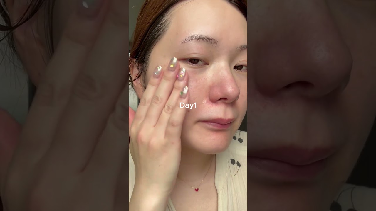 レベルMAX🚨流行りのニードルセラムの変化が凄い..!! #美容 #カタン #カタンダーマヒットセラム #スキンケア #skincare #垢抜け #katan