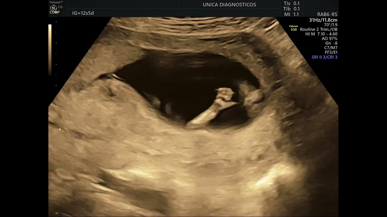 Ultrassom morfológico de primeiro trimestre