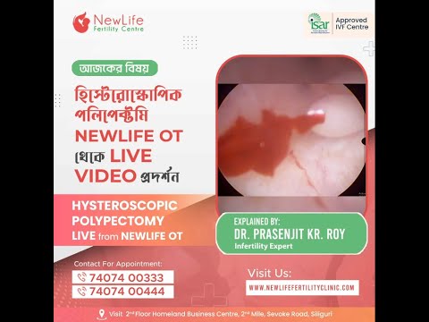 Hysteroscopic Polypectomy LIVE from OT