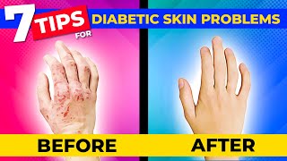 7 Tips To Avoid The Common Skin Problems Caused By Diabetes