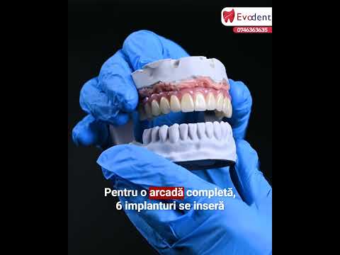 Cât durează o intervenție cu implanturi dentare?