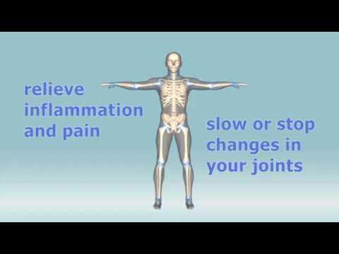 What are the treatments for rheumatoid arthritis?