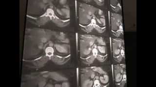 Endocrine Surgery - Adrenal Glands 1 + Imaging