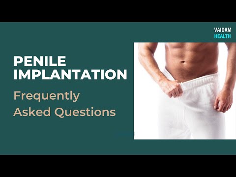 Penile Implantation- Frequently Asked Questions