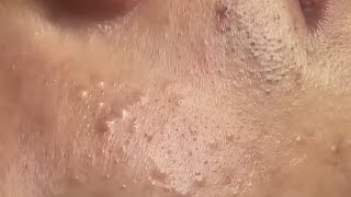 Relaxing Acne Cleansing with LinhMyDang  #594