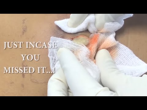 Squeezing abscess full of pus * Squirt alert *