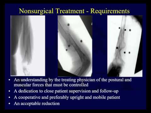 Humeral Shaft Fractures 1 - Indications, nonop tx, surgical approaches (OTA lecture series III u04a)