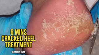 Remove Cracked Heels - So satisfying, 6 mins Cracked heel treatment by miss foot fixer