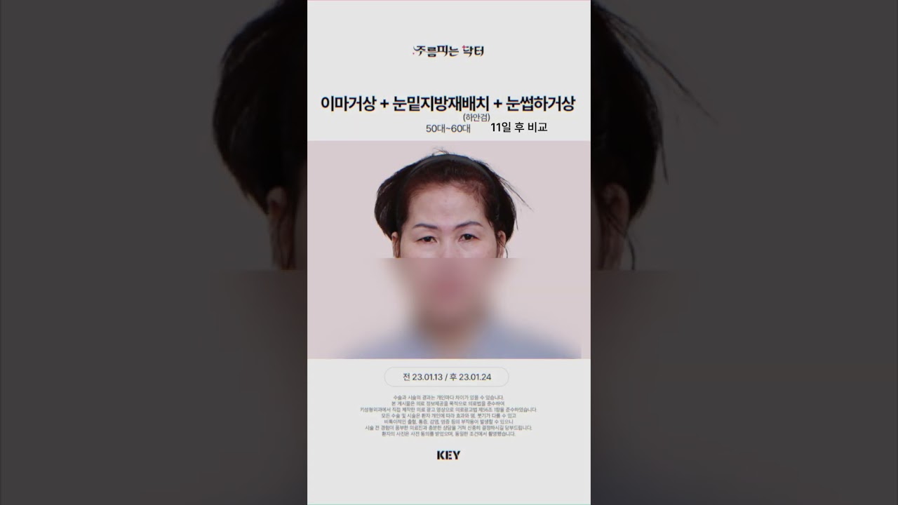 대구 이마거상 50대 대구키성형외과