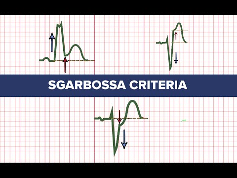 Sgarbossa Criteria - MEDZCOOL