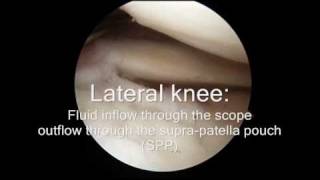 Arthroscopic Fluid Flow Video - Dr. Alan M. Reznik