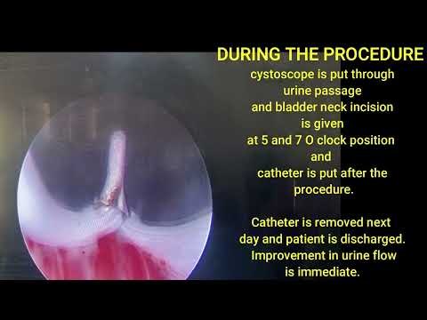 Bladder Neck Incision - Indications, Types and Complications