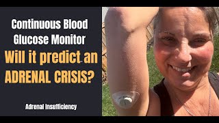 ADDISON'S DISEASE | WILL IT PREDICT AN ADRENAL CRISIS???