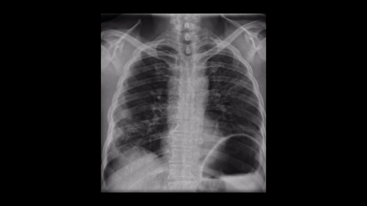 HERNIA DIAFRAGMÁTICA EN ADULTO CASO CLÍNICO CAUSAS SÍNTOMAS Y TRATAMIENTO HERNIA DIAFRAGMÁTICA